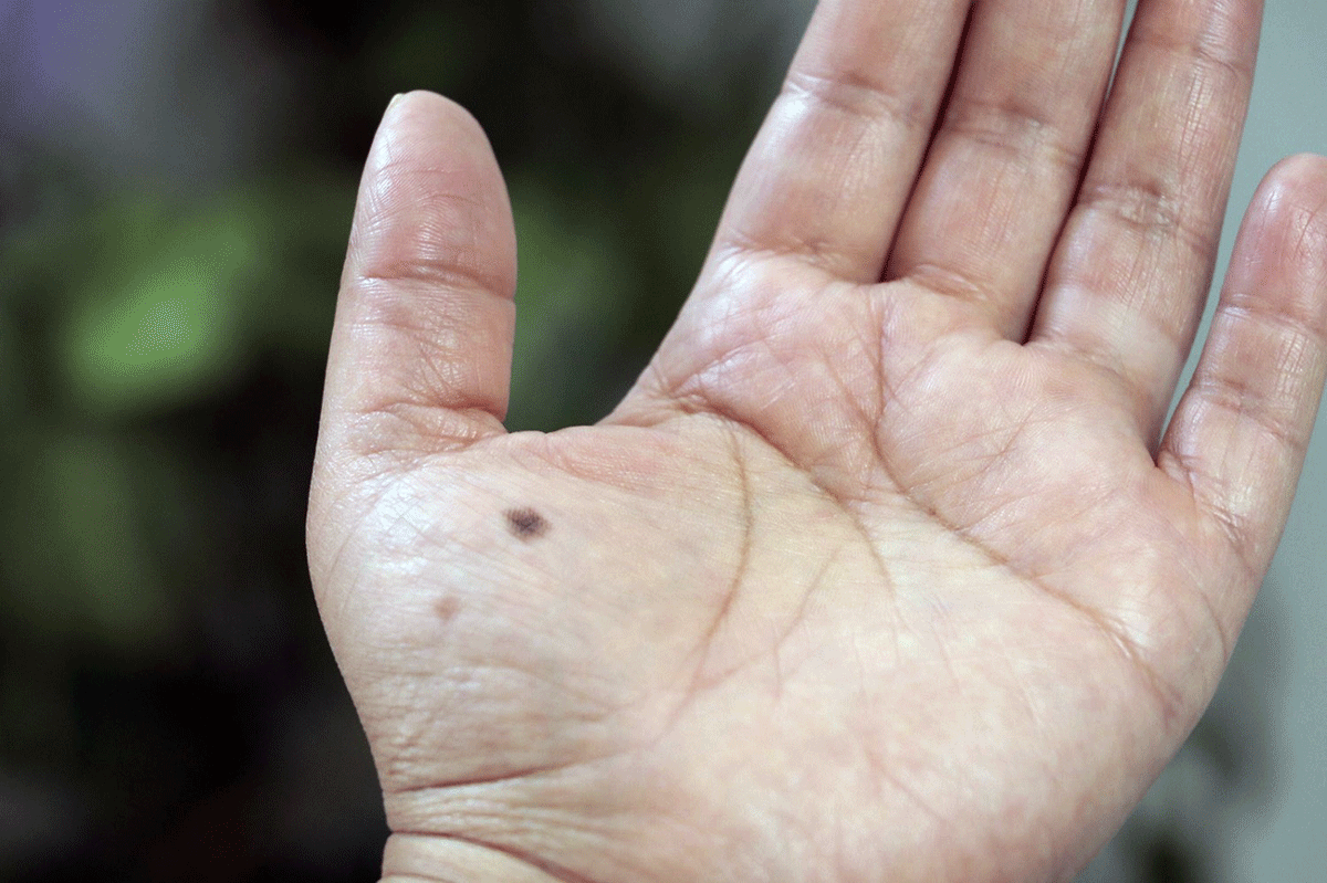 ¿Tienes algún lunar extraño en rostro o cuerpo? Cuitado, puede ser cáncer